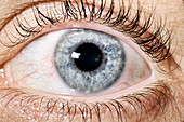 Foreign body in eye