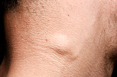 Swollen lymph node in infection