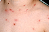 Chickenpox rash