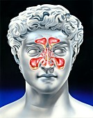 Sinusitis,illustration