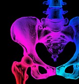 Normal hip and pelvis,3D CT scan