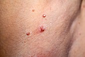 Molluscum contagiosum papules