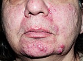 Acne rosacea before treatment