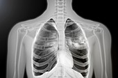 Tuberculosis,X-ray illustration