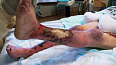 Infected legs in ischaemia