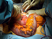 Megacolon resection in ischaemic colitis