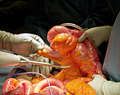 Megacolon resection in ischaemic colitis