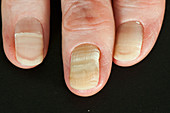 Yellow nail syndrome