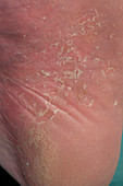 Psoriasis