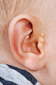 Accessory auricle