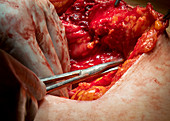 Abdominal surgery