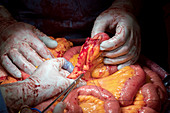 Small intestine resection surgery