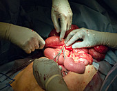 Bowel surgery