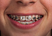 Fixed orthodontic braces