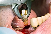 Premolar tooth extraction