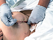 Suturing abdominal surgical wound