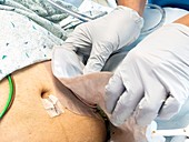 Colostomy pouch handling