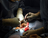 Hernia repair surgery