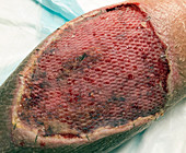 Skin graft on large leg ulcer