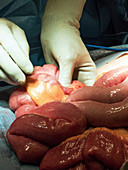 Bowel obstruction surgery