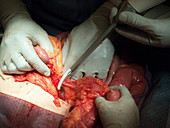 Mesenteric stage of intestinal surgery