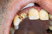 Upper incisor before dental crown surgery