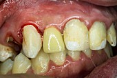 Upper incisor with plastic dental crown