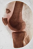 Knee injury X-ray,early 20th century
