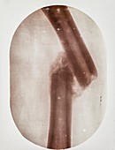 Broken bone X-ray,early 20th century