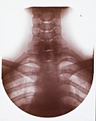 Cervical spine X-ray,early 20th century