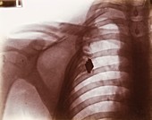 Shrapnel X-ray,early 20th century