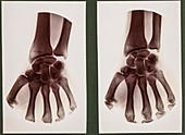 Wrist X-rays,early 20th century