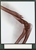 Broken arm X-ray,early 20th century