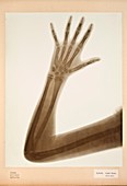 Child's arm X-ray,1896
