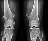 Knees in Ollier disease,X-ray