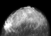 Breast lump,X-ray