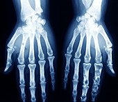 Hands in chondrodystrophy,X-ray