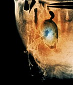 Salivary stone,X-ray