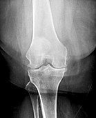 Osteoarthritis of the knee,X-ray