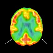 Brain in Alzheimer's disease,SPECT