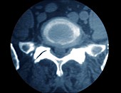 Spinal disc degeneration,CT scan