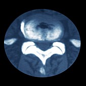 Spinal disc protrusion,CT scan