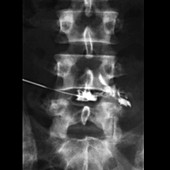 Slipped disc,X-ray