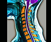 Normal cervical vertebra,MRI scan