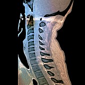 Spinal fracture,CT scan