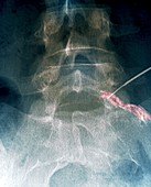 Spinal anti-inflammatory injection,X-ray