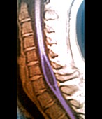 Spinal cord cyst,MRI