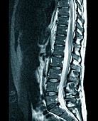 Spine in multiple sclerosis,MRI