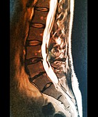 Spinal arachnoiditis,MRI