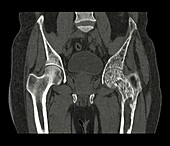 Hips in Paget's disease,CT scan